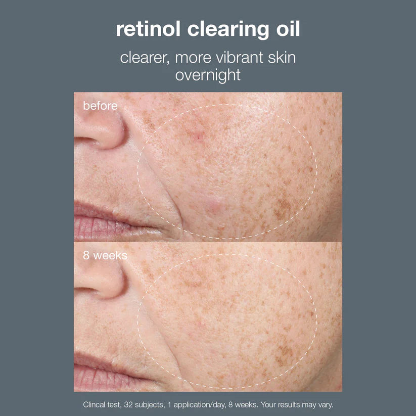 retinol acne clearing oil